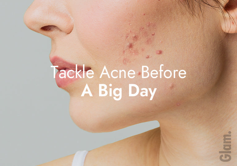 tackle acne before a big day