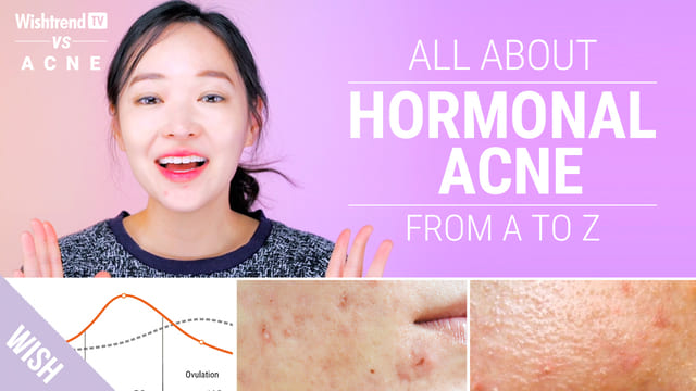 How to Cure Hormonal Acne : Lifestyle & Skincare Tips!