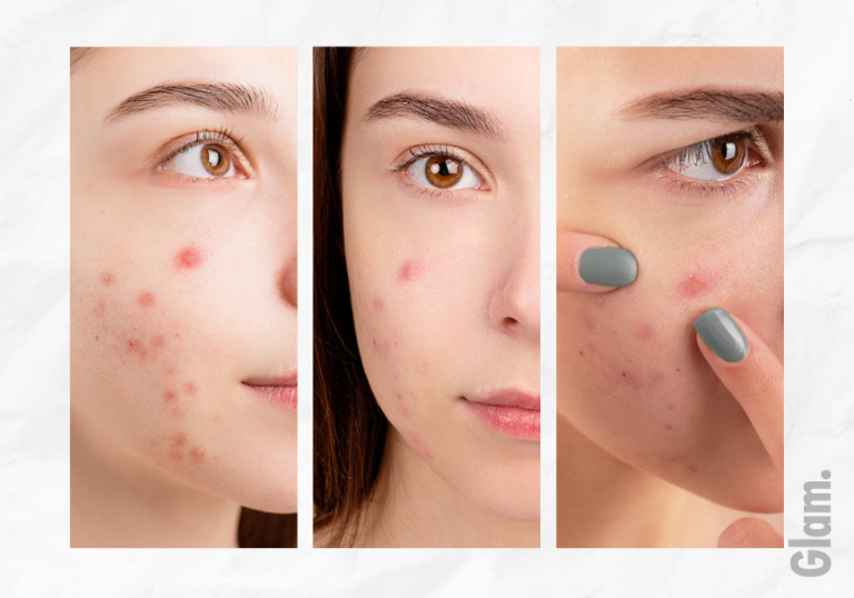 acne myth