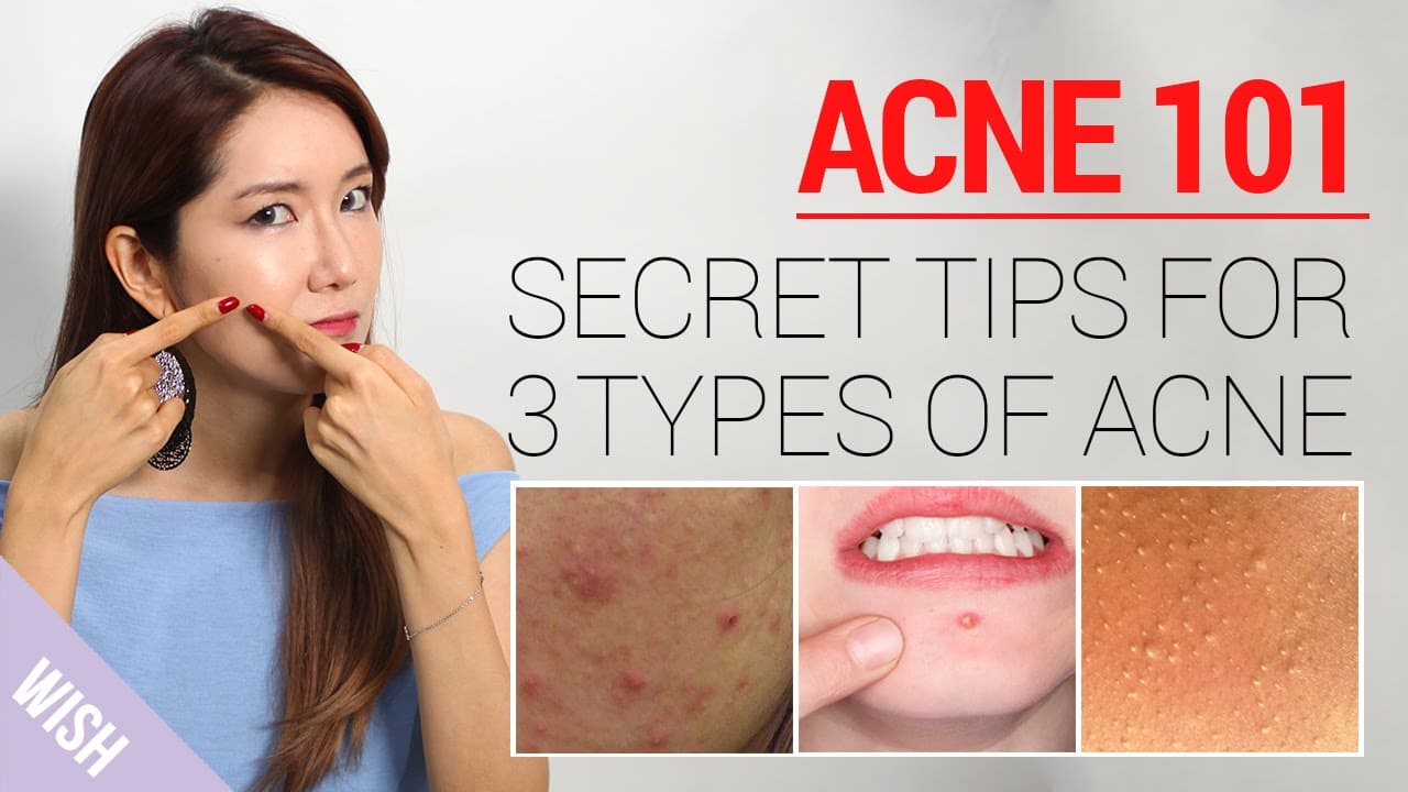 Acne 101 | How to Take Care of Acne At Home (Types & Treatment)