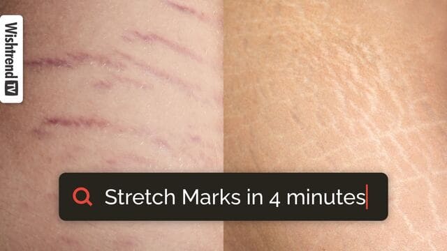 How To Get Rid Of Stretch Marks? | From Causes To Treatment