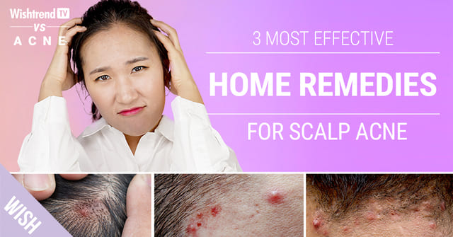 How to Get Rid of Scalp & Back of Neck Acne Naturally