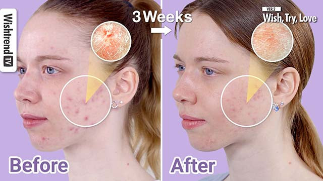 How to Treat Acne with 6 Major Tips to Keep it Under Control