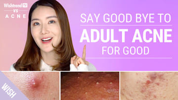 How to completely get rid of adult acne