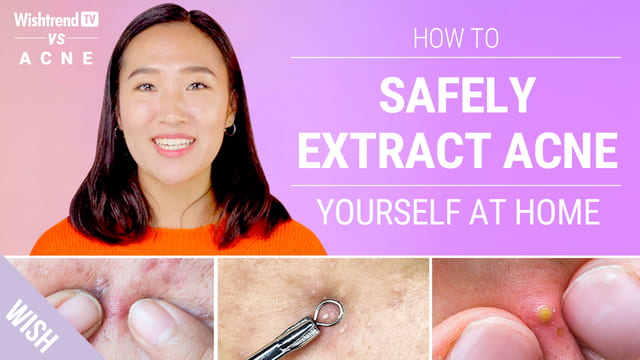 Proper Acne Extraction Steps Without Leaving a Scar!