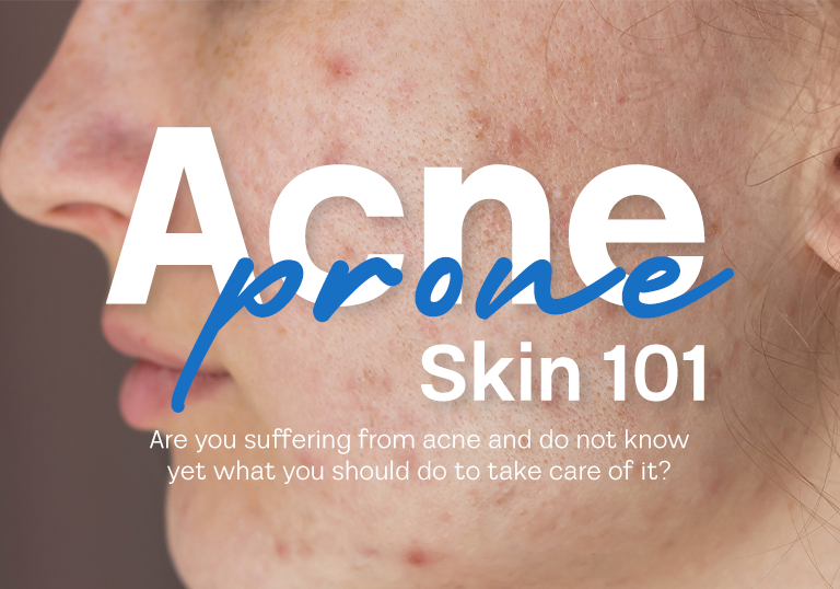 Acne Prone Skin 101: All You Need to Know About Acne-Prone Skin 