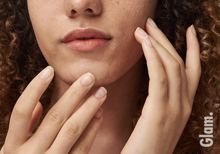 Reasons Not to Pop Your Pimple and How to Pop it If You Have to