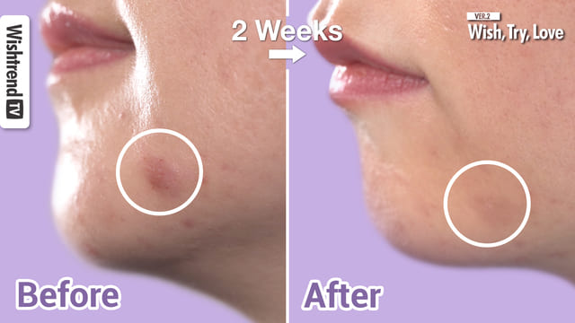 How to get rid of Chin Acne, Maskne and Maskne Treatment Skincare Tip