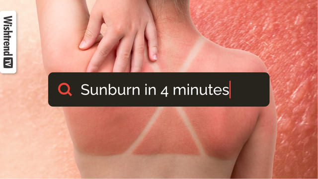 SUNBURN 101! What SunBurn Causes To Our Skin? Home Care Treatment?