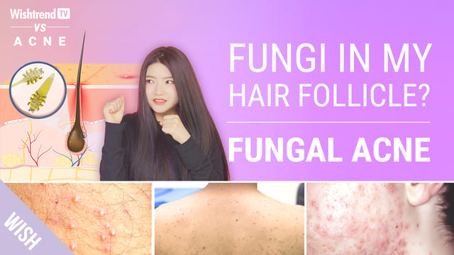 That Acne Never Goes Away? Try Fungal Acne-SAFE Skincare Routine