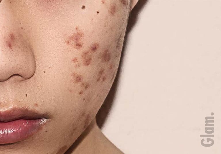 3 Secrets on How to Cure Acne Without Popping Them