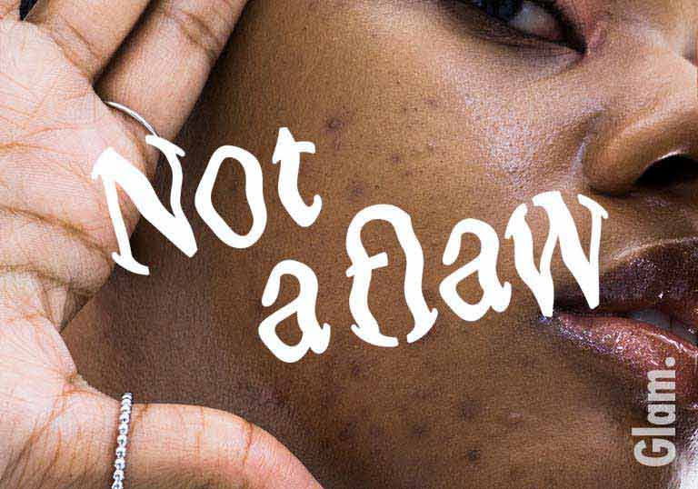 #NotAFlaw The Story Behind Wishtrend's Journey to Skin Positivity