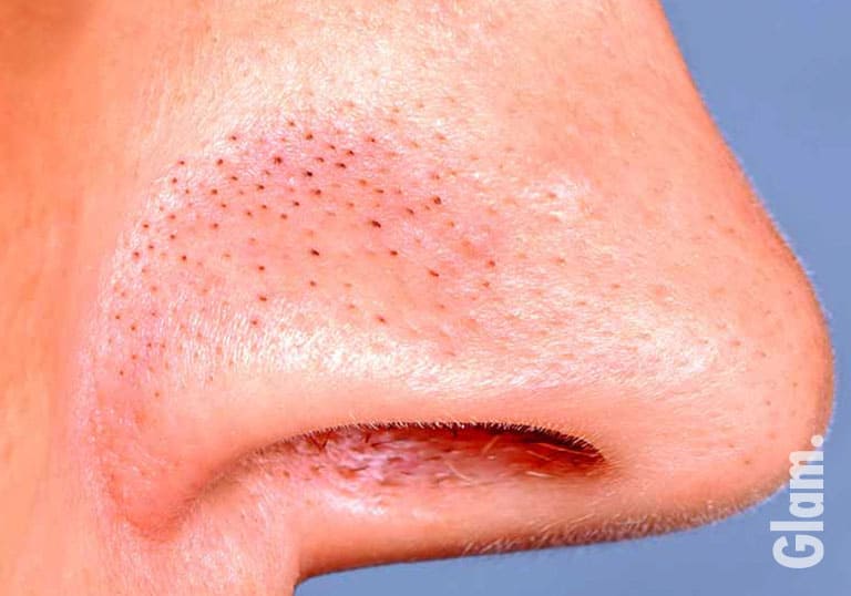 What are Blackheads & Why Do We Get Them? Blackheads 101