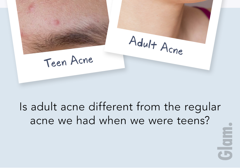The difference between teen acne and adult acne