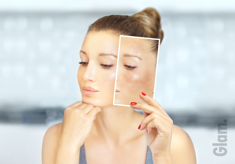Hyperpigmentation: Causes and How to Avoid It