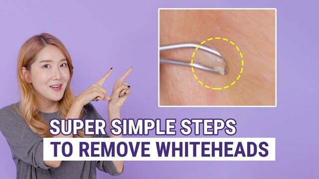 How To Remove Whiteheads | The Best Whitehead Removal & Prevention Box