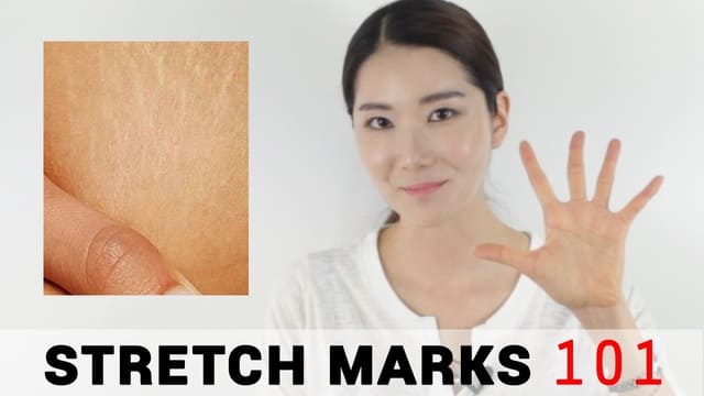 5 Essential Tips for Stretch Marks