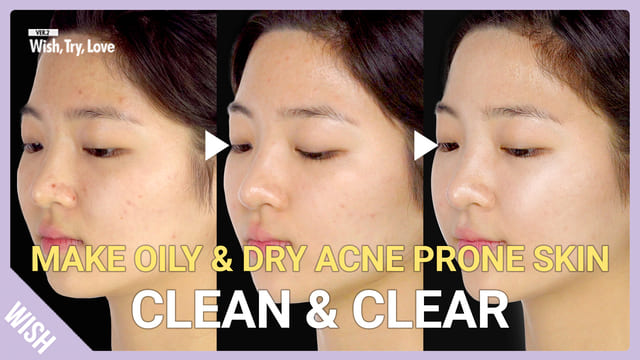 5 Essentials for Oily, Dry Acne Prone Skin! How to Get Clear Skin at Home