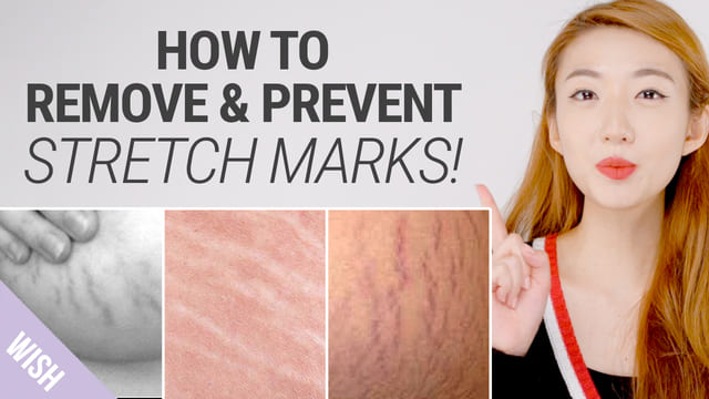 How To Get Rid of Stretch Marks Fast! Natural Remedies for Stretch Mark Removal