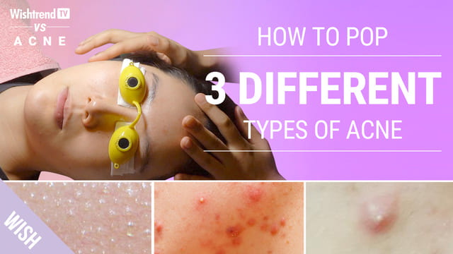 How to Extract 3 Different Types of Acne as Told By A Dermatologist