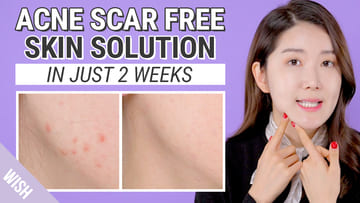 How to Get Pigmentation & Acne Scar Free Skin