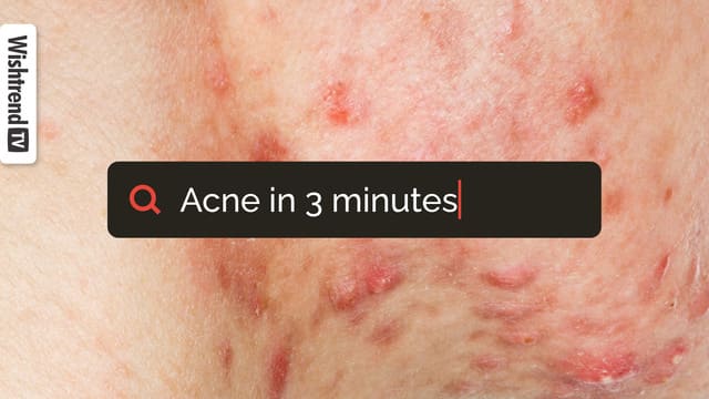How to Get Rid of Acne! | Face? Vitamin A? Retinol? Treatment?