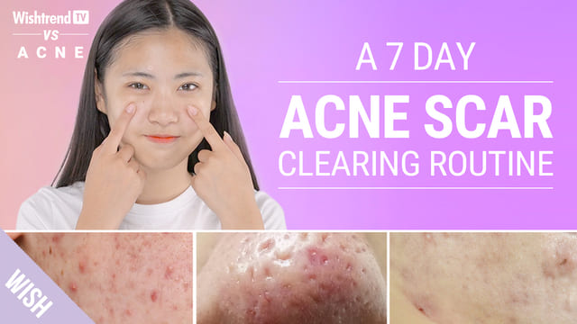 How to Prevent & Quickly Remove Various Types of Acne Scars