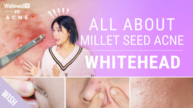 Skincare Routine to Remove Millet Seed Acne AKA Whiteheads