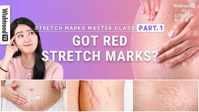 Stretch Mark Master Class PART. 1 | How to reduce and prevent Stretch Marks
