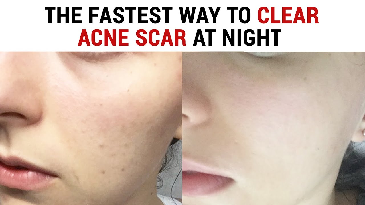 The Most Effective Night Care Routine to Clear Acne Scars